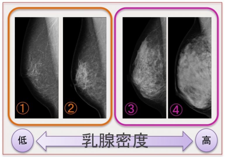 高濃度乳腺の画像